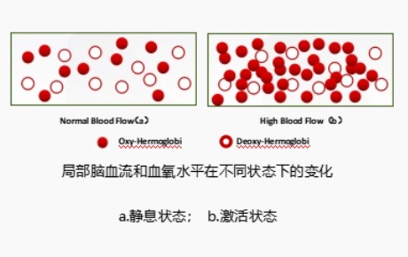 fNIRS研究表明：有/無(wú)自殺意念的抑郁癥個(gè)體在特定任務(wù)期間DLPFC激活不同